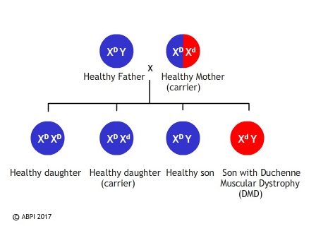 Duchenne muscular dystrophy is a sex linked recessive disease, inherited on the X chromosome