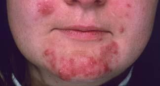 Skin Infections 3